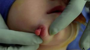 In the USA, a strange girl with two mouths was born